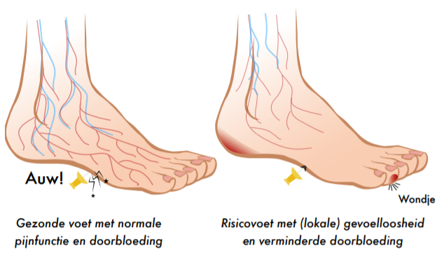Diabeten | Podotherapie Het Gooi